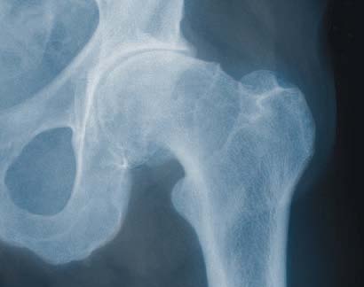 Hüftgelenksarthrose Orthopädie Wilhelmstraße Wiesbaden