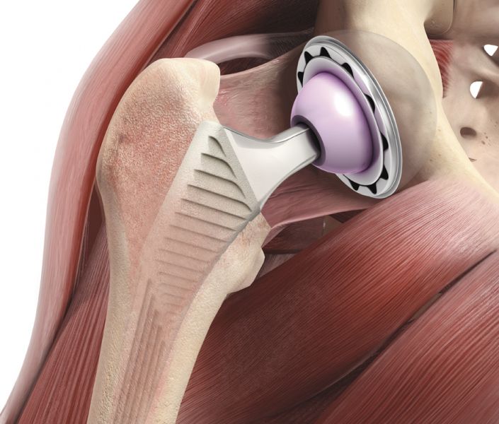 Hüftgelenksarthrose Orthopädie Wilhelmstraße Wiesbaden